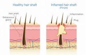 Healthy vs. inflamed hair shaft diagram.