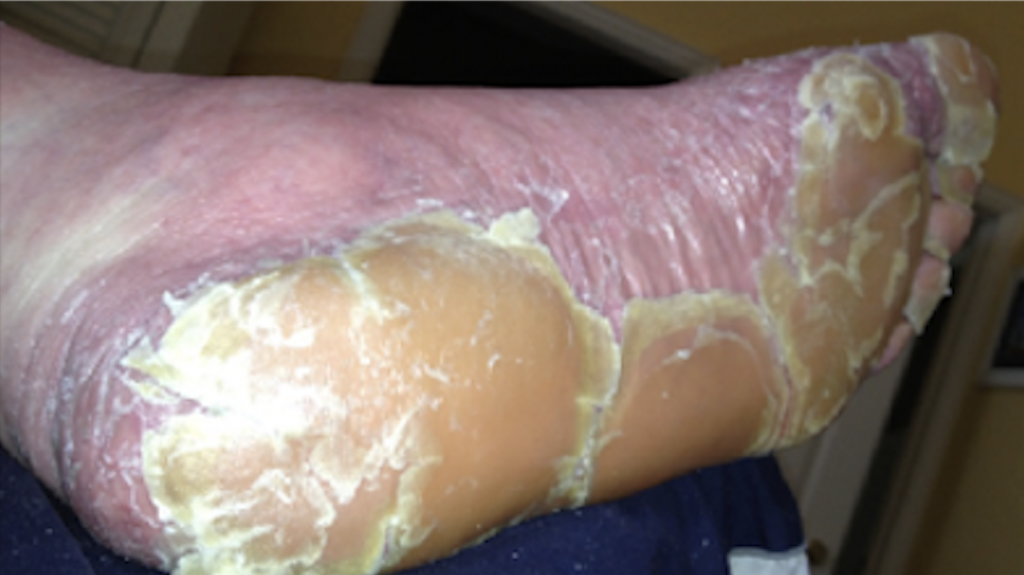 Foot with peeling, flaky skin condition.
