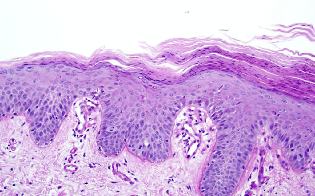 pityriasis rubra pilaris