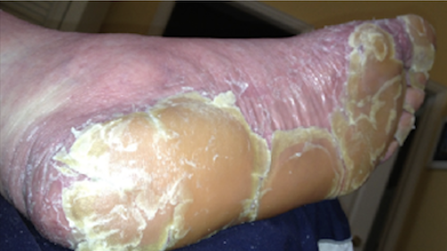 Foot with severe skin peeling and dryness.