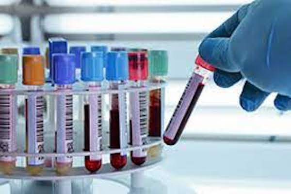 Blood samples in a laboratory test tube.